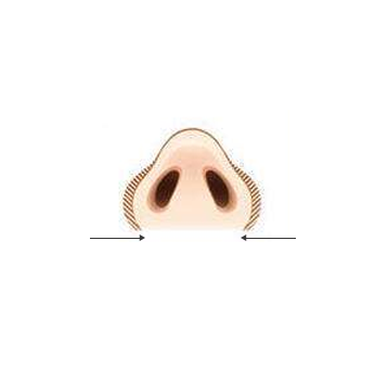 鼻翼缩小